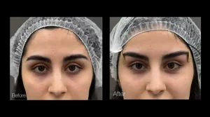 لیفت چشم با نخ