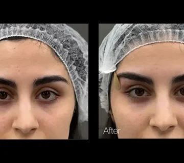 لیفت چشم با نخ