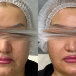 لیفت صورت با نخ