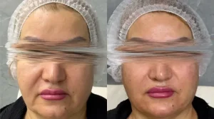 لیفت صورت با نخ