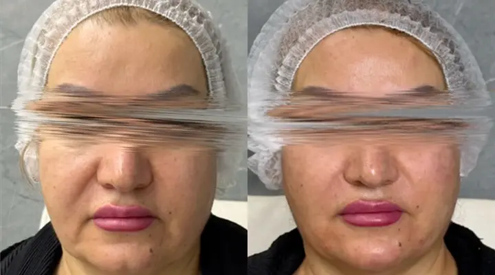 لیفت صورت با نخ