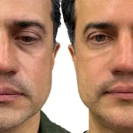 تزریق فیلر زیر چشم