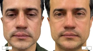 تزریق فیلر زیر چشم