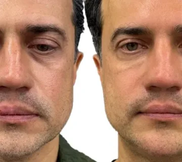 تزریق فیلر زیر چشم