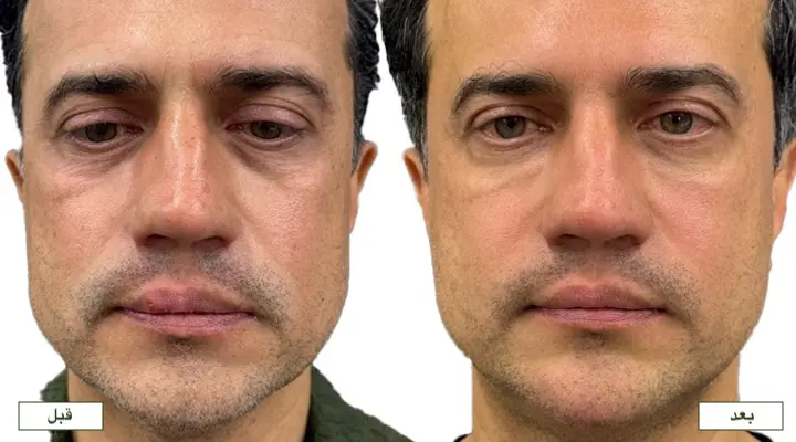 تزریق فیلر زیر چشم