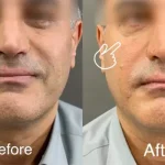 بوتاکس زیر چشم