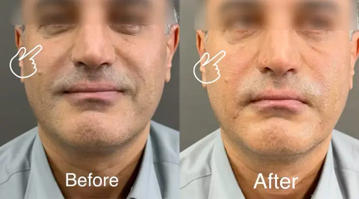 بوتاکس زیر چشم