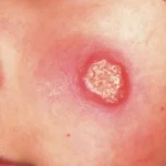 سالک cutaneous leishmaniasis