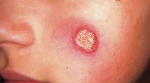 سالک cutaneous leishmaniasis