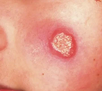 سالک cutaneous leishmaniasis