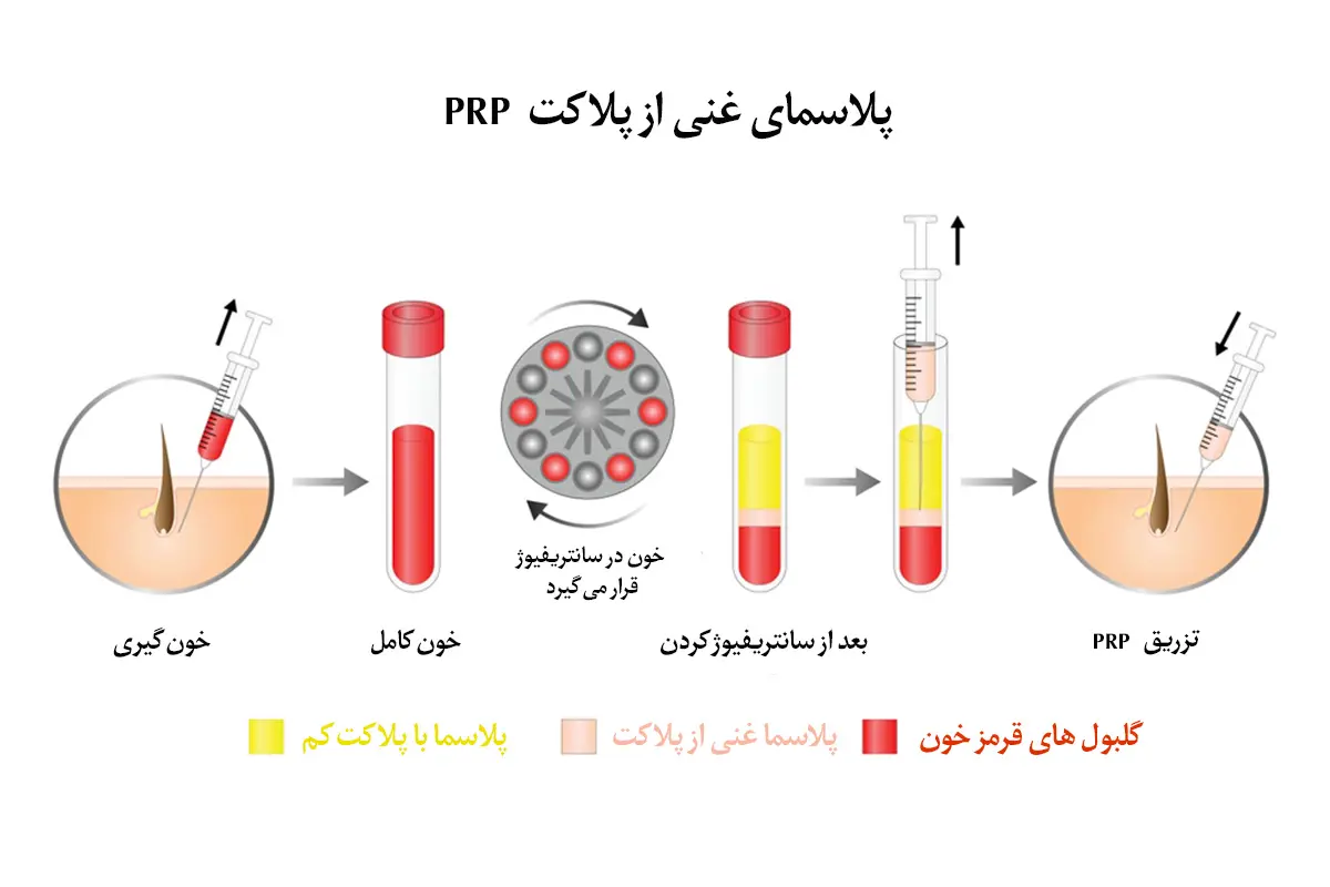 مراحل استخراج PRP مراحل استخراج PRP