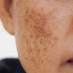 درمان لک صورت