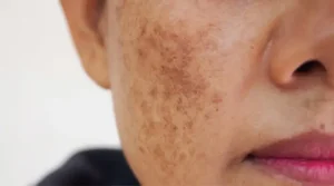 درمان لک صورت