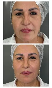 تزریق دیمونو