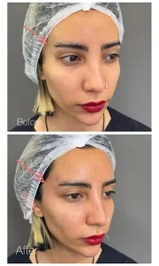 تزریق دیمونو