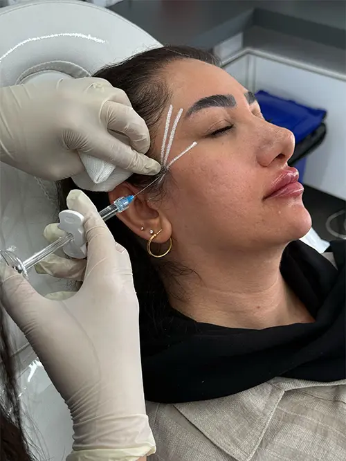 تزریق فیلر شقیقه