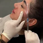 تزریق فیلر شقیقه