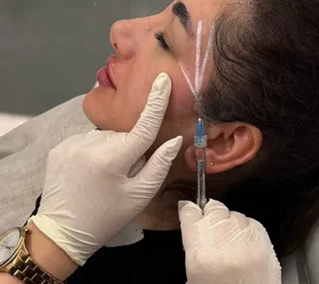 تزریق فیلر شقیقه