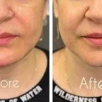 تزریق ژل خط خنده