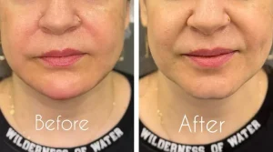 تزریق ژل خط خنده