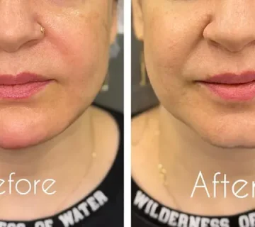 تزریق ژل خط خنده