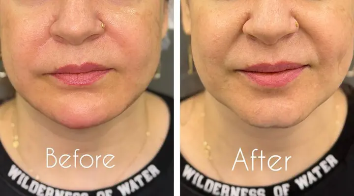 تزریق ژل خط خنده