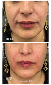 تزریق ژل خط خنده تزریق ژل خط خنده