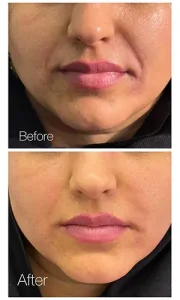 فیلر خط خنده فیلر خط خنده