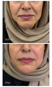 تزریق ژل خط خنده تزریق ژل خط خنده