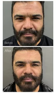 تزریق ژل خط خنده تزریق ژل خط خنده