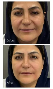 تزریق ژل خط خنده تزریق ژل خط خنده