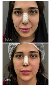 تزریق ژل خط خنده تزریق ژل خط خنده