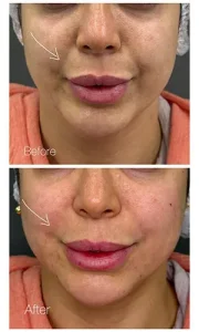 تزریق ژل خط خنده تزریق ژل خط خنده