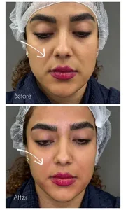 تزریق ژل خط خنده تزریق ژل خط خنده