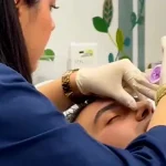 لیفت بینی بدون جراحی