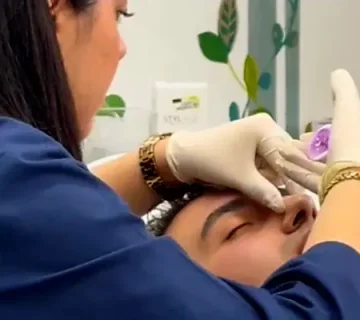 لیفت بینی بدون جراحی