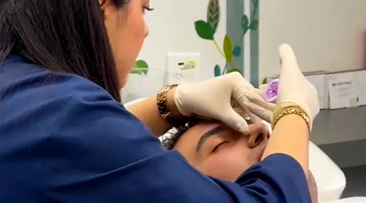 لیفت بینی بدون جراحی