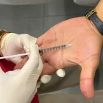 بوتاکس کف دست