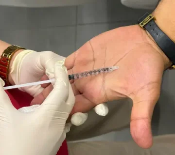 بوتاکس کف دست